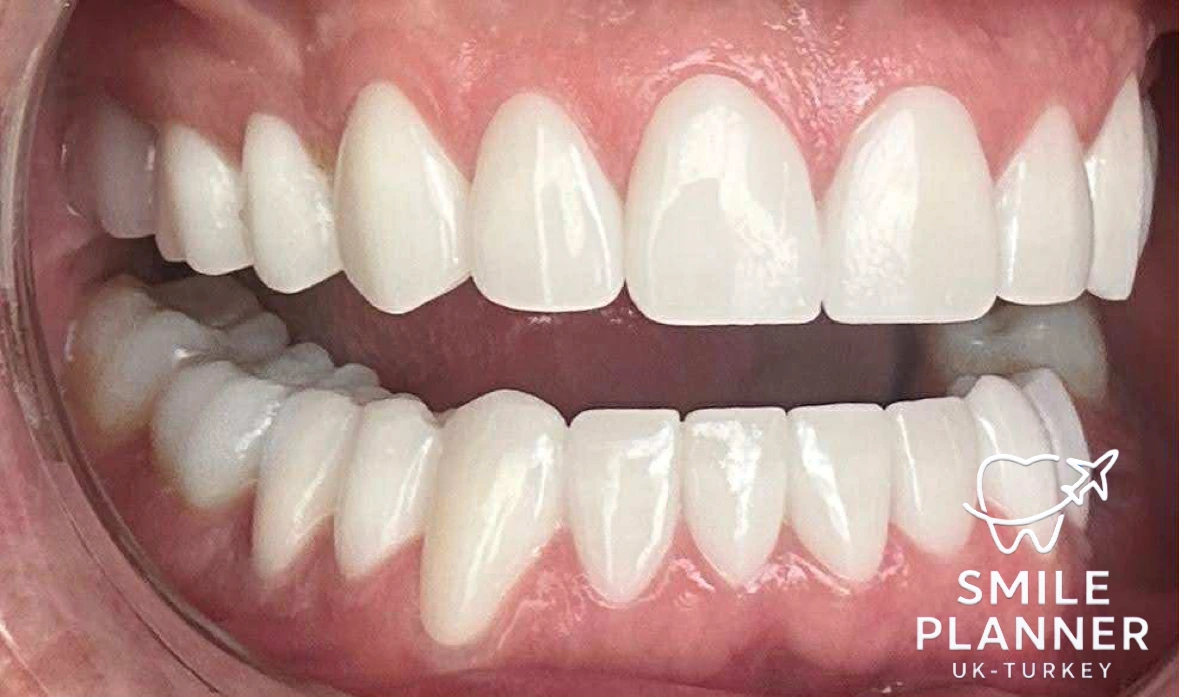 UK patient smile transformation all-on-5 in Turkey